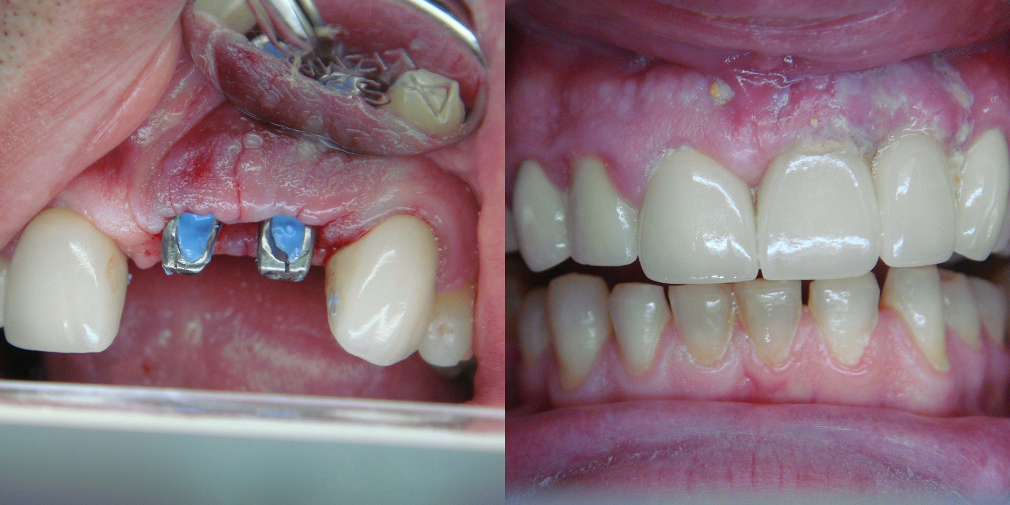 Dental Prices in Thailand Bangkok Dental Prices Thailand Dental