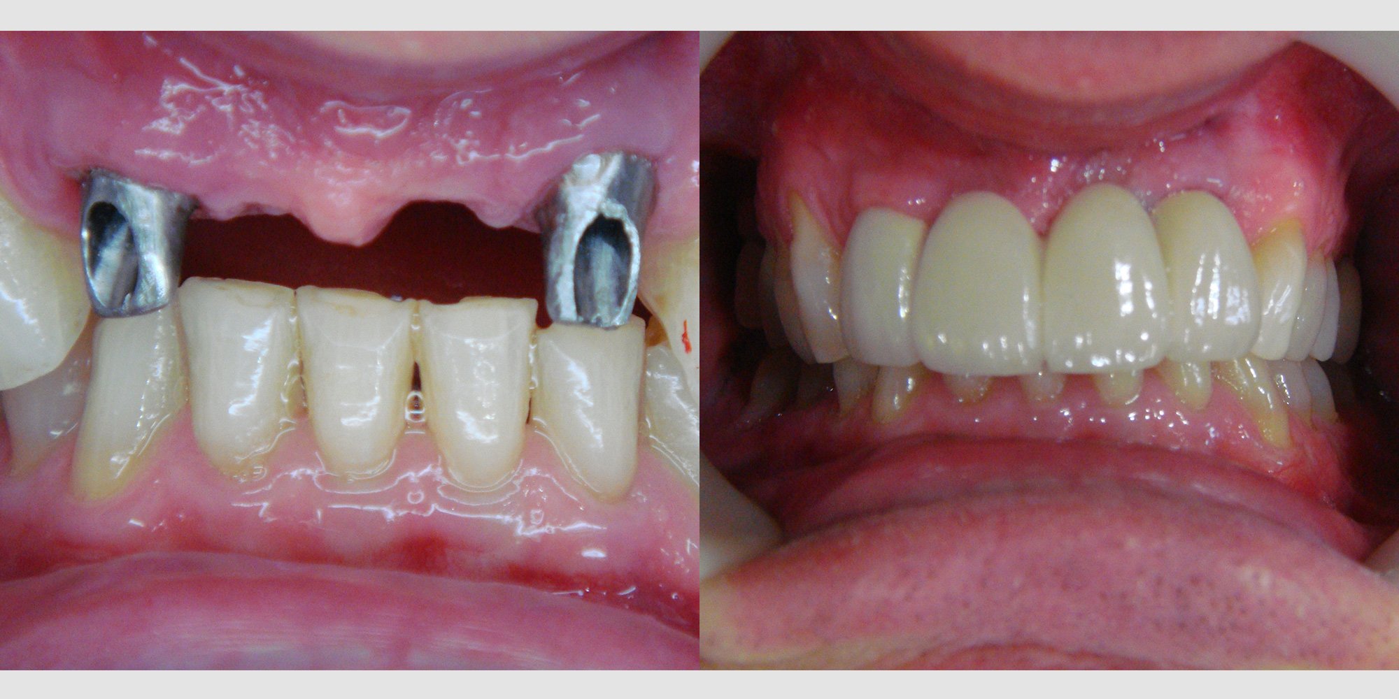 Dental Prices in Thailand Bangkok Dental Prices Thailand Dental