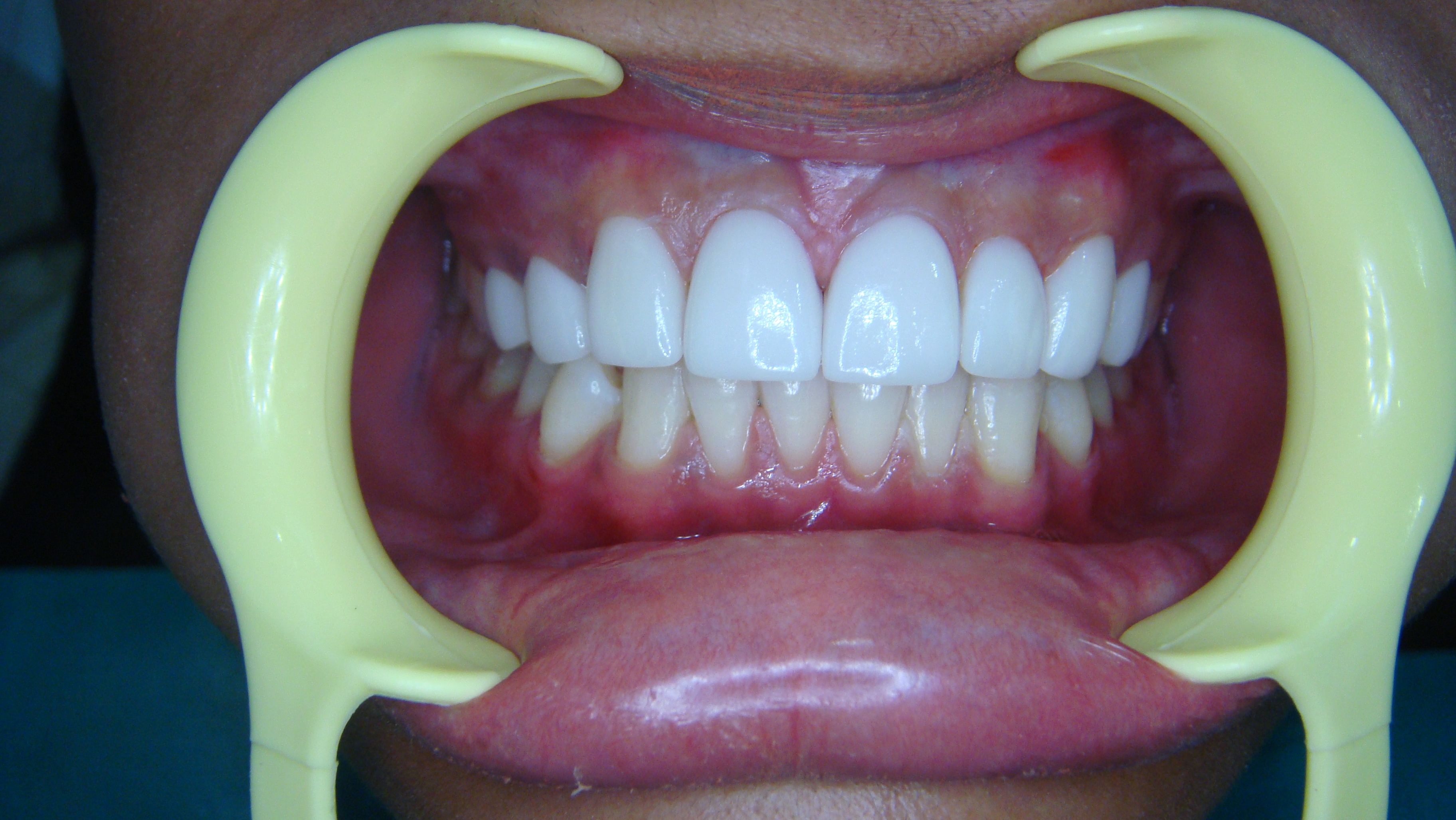 Before After Porcelain Veneer in Bangkok, Thailand at Dr. Sunil