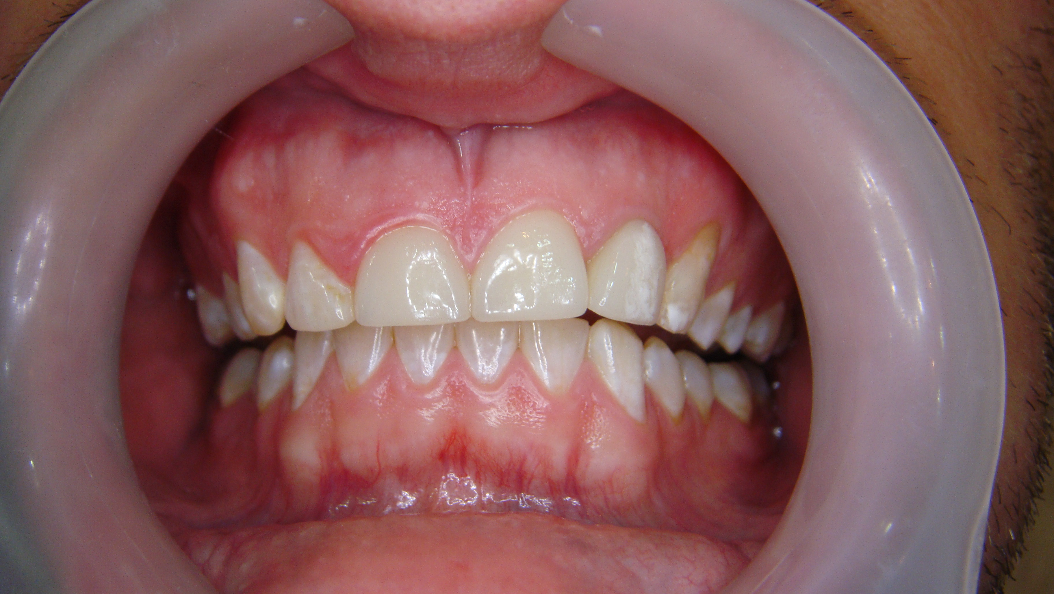 Before After Porcelain Veneer in Bangkok, Thailand at Dr. Sunil