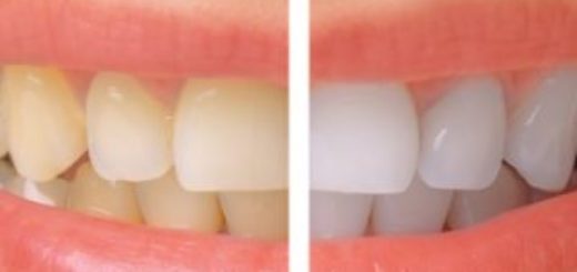 effectiveness of teeth whitening products
