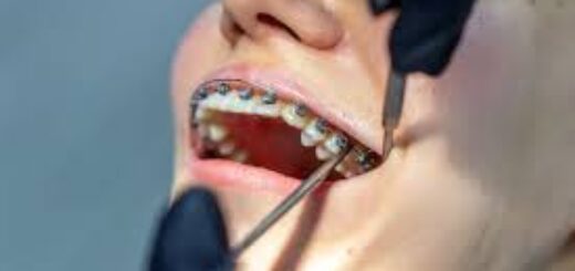 Orthodontics Procedure