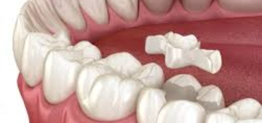 Dental Inlays