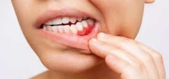 Myths Related To Gums and Gum Related Problems