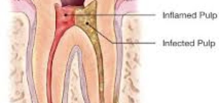 Root Canal Therapy: Powerful Relief for Tooth Pain