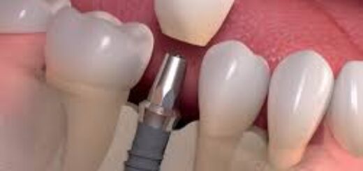 Bangkok Dental Implants