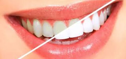 Teeth Whitening Services