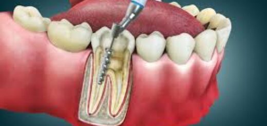 Root Canal Myths vs Facts