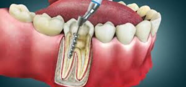 Root Canal Myths vs Facts