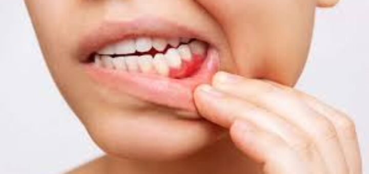 Gum Disease Overview about the common problem