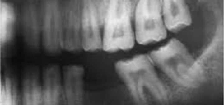 Turner Hypoplasia