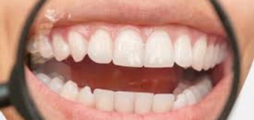 Fluorosis