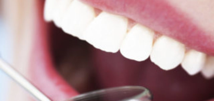 Composite Resin