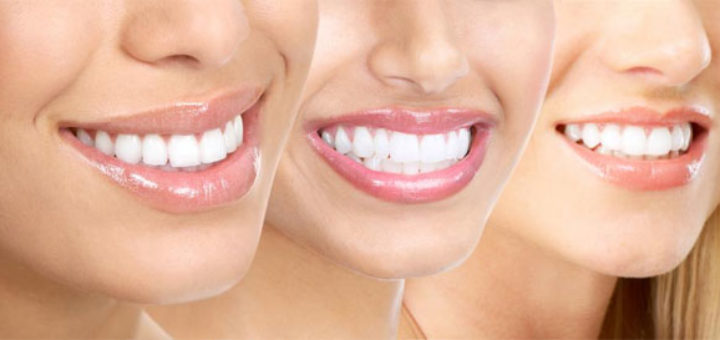 Gum Lift Procedure