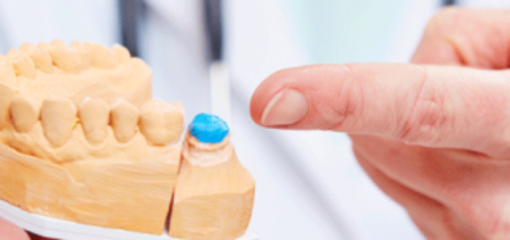 Dental crowns and bridges
