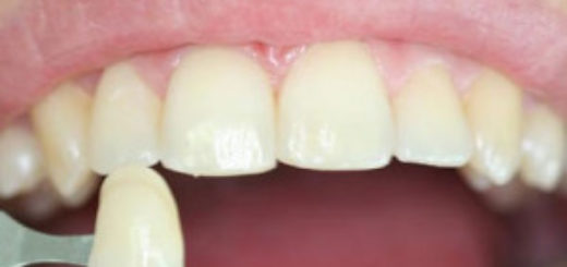 Porcelain Veneers - All you need to know about