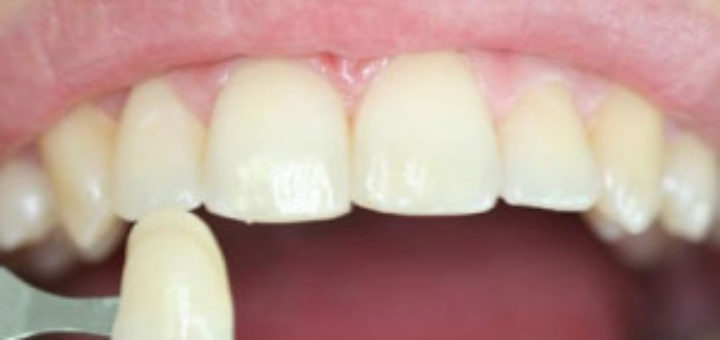Porcelain Veneers Cost