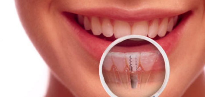 Teeth Implant