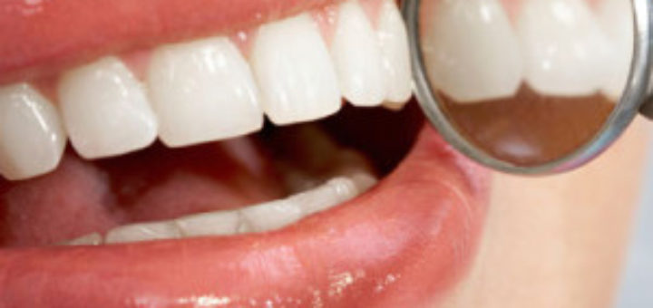 Laser Teeth Whitening Cost