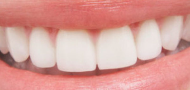 Smile and the benefits of Teeth Whitening