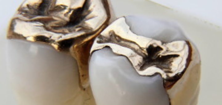 Tooth Coloured Fillings