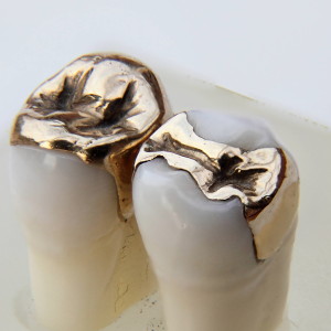 Fill Inlay Color Tooth Coloured Fillings in Bangkok | Dr. Sunil Dental