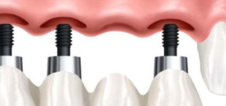 Implant Supported Bridge