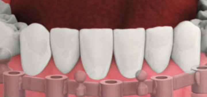 Implant Supported Denture
