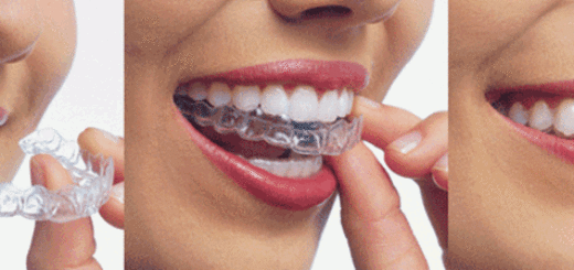 Say good bye to Metal and Porcelain Braces - Welcome Invisalign