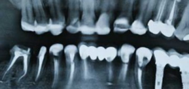 Dental Treatments in Thailand