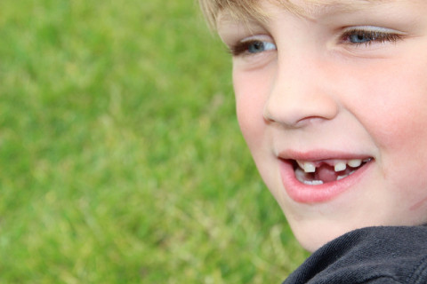 a child having chipped teeth