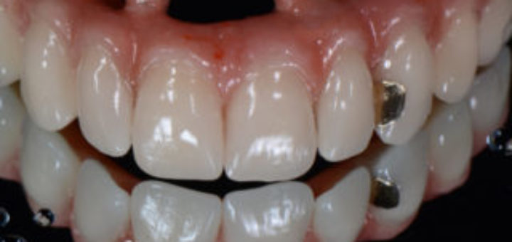 All-on-Four Implants
