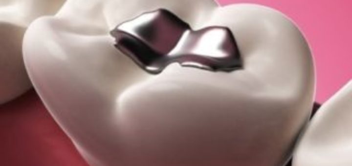 Amalgam filling removal