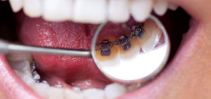 Braces