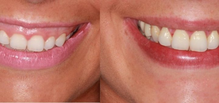 Crown Lengthening