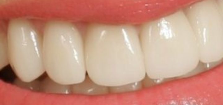 Crown Lengthening Procedure