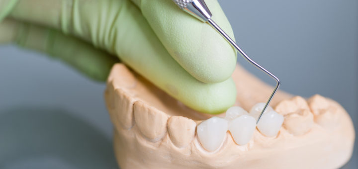 Dental Crown Steps