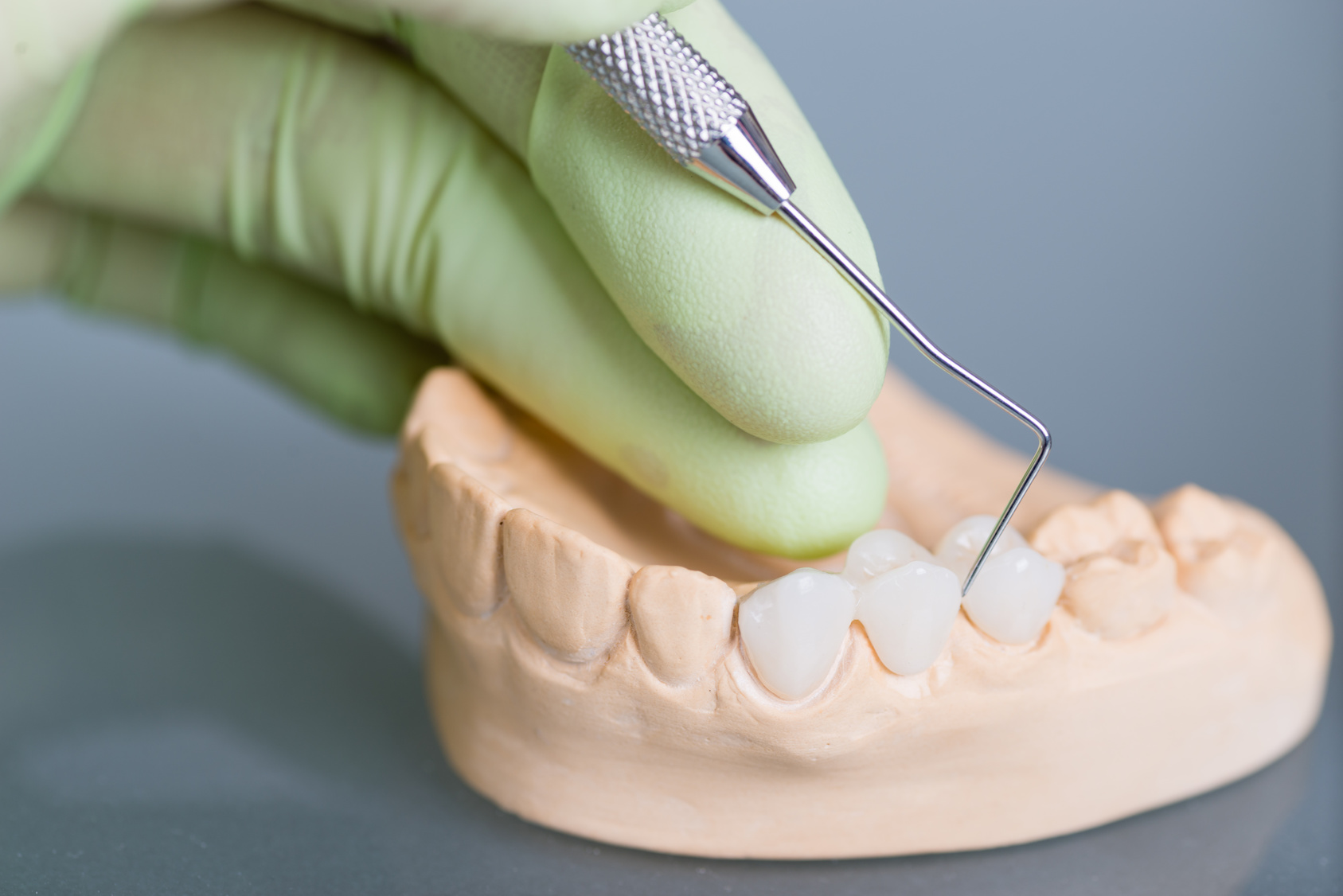 (What are) Dental Crown Steps and HOW are they Performed