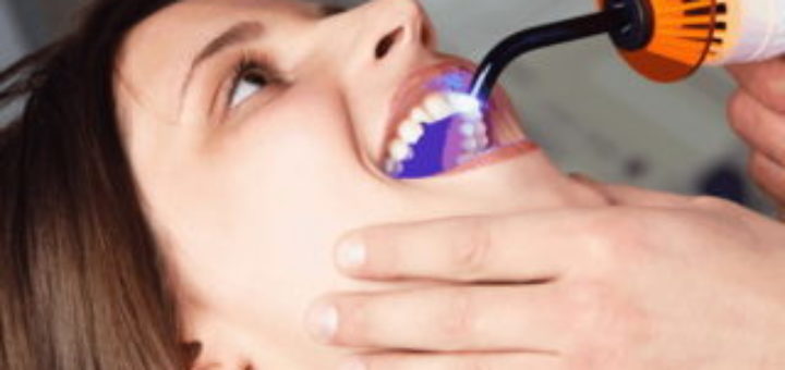dental fillings
