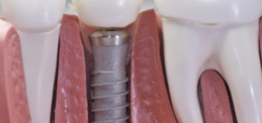 Role of Dental Implant