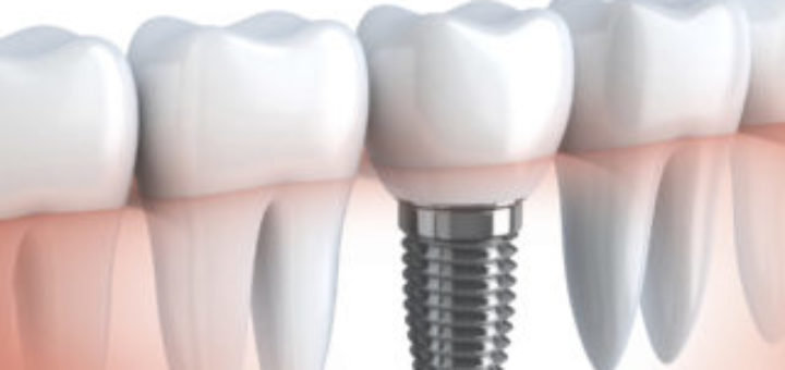 Dental Implants