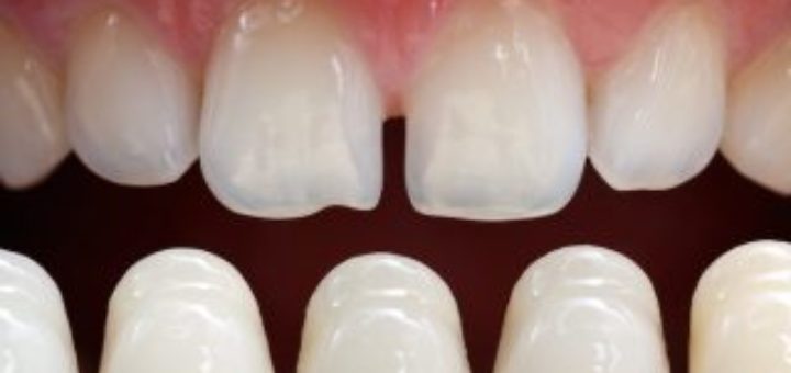 Dental Veneers
