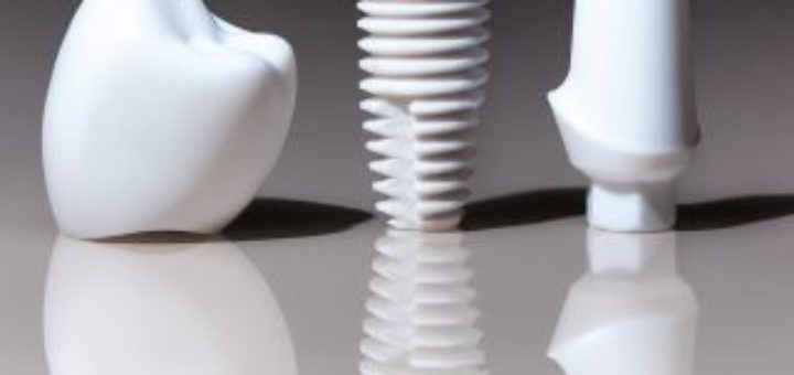 Dental Implants