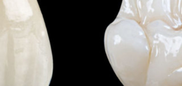 Dental Crown Types