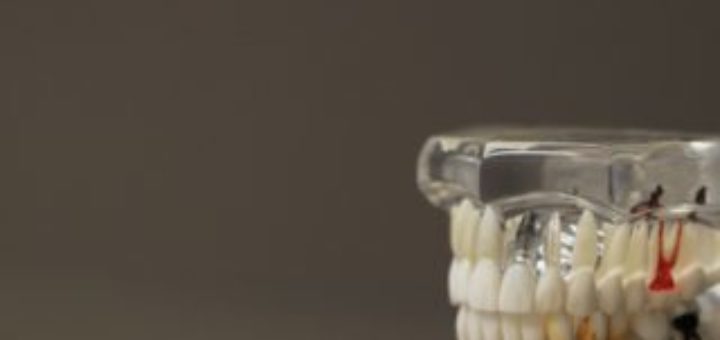 Teeth Fillings