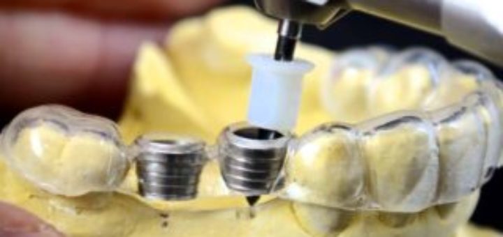 Dental Implant Surgery