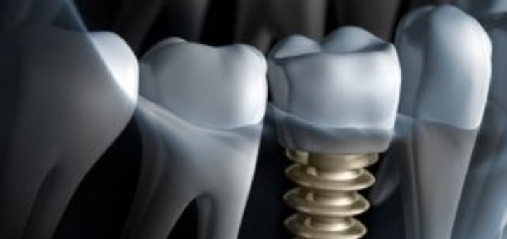 dental appliances