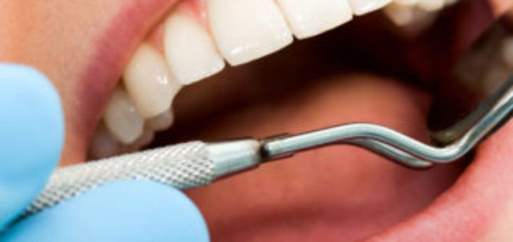 Dental Implants
