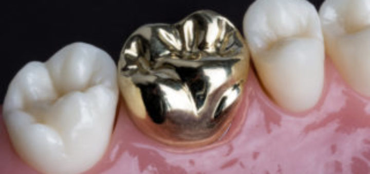 Dental Restorations