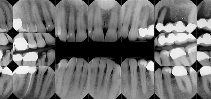 Bone Grafting